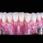 Why Invisible Braces Require Discipline And Dedication