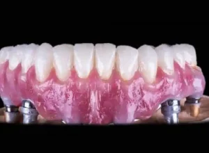 Why Invisible Braces Require Discipline And Dedication